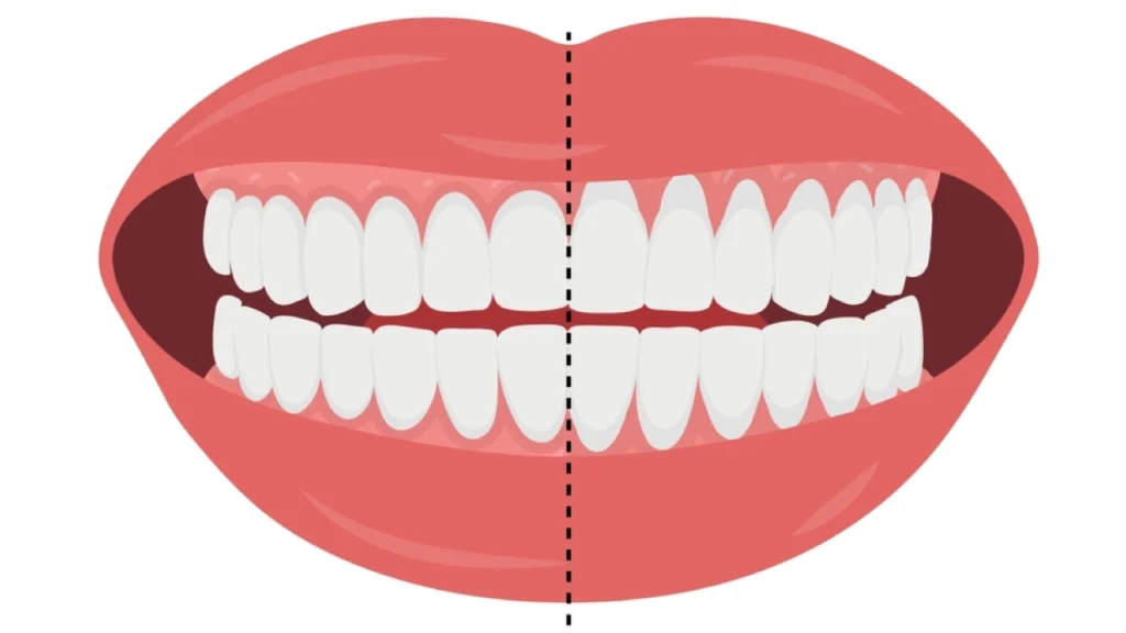 Causes of Gum Recession