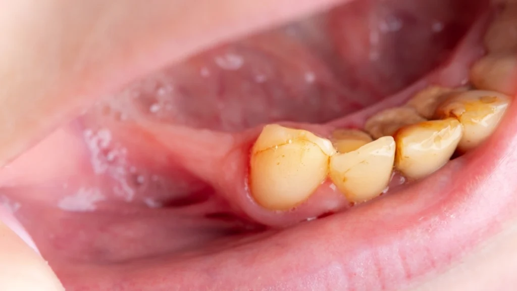 Plaque and Tartar Damage Gums