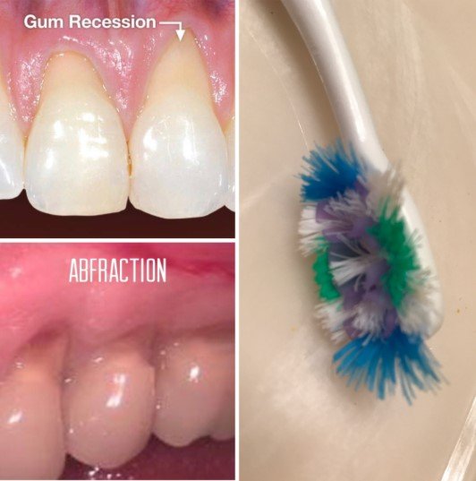 Signs You're Brushing Too Hard Right Now