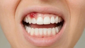 Sugar Cause Gum Disease or Cavities