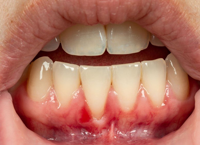 Why Bottom Teeth Are Prone to Recession