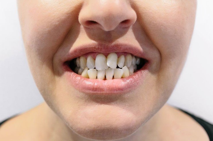 Misaligned Teeth or Bite Problems