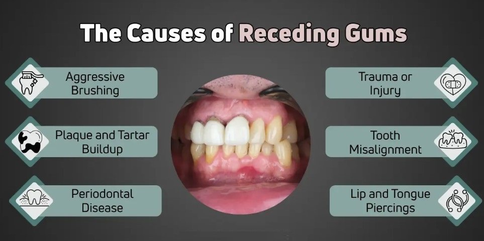 Causes of Receding Gums in Adults
