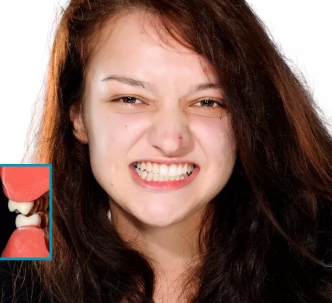 Teeth Grinding (Bruxism)